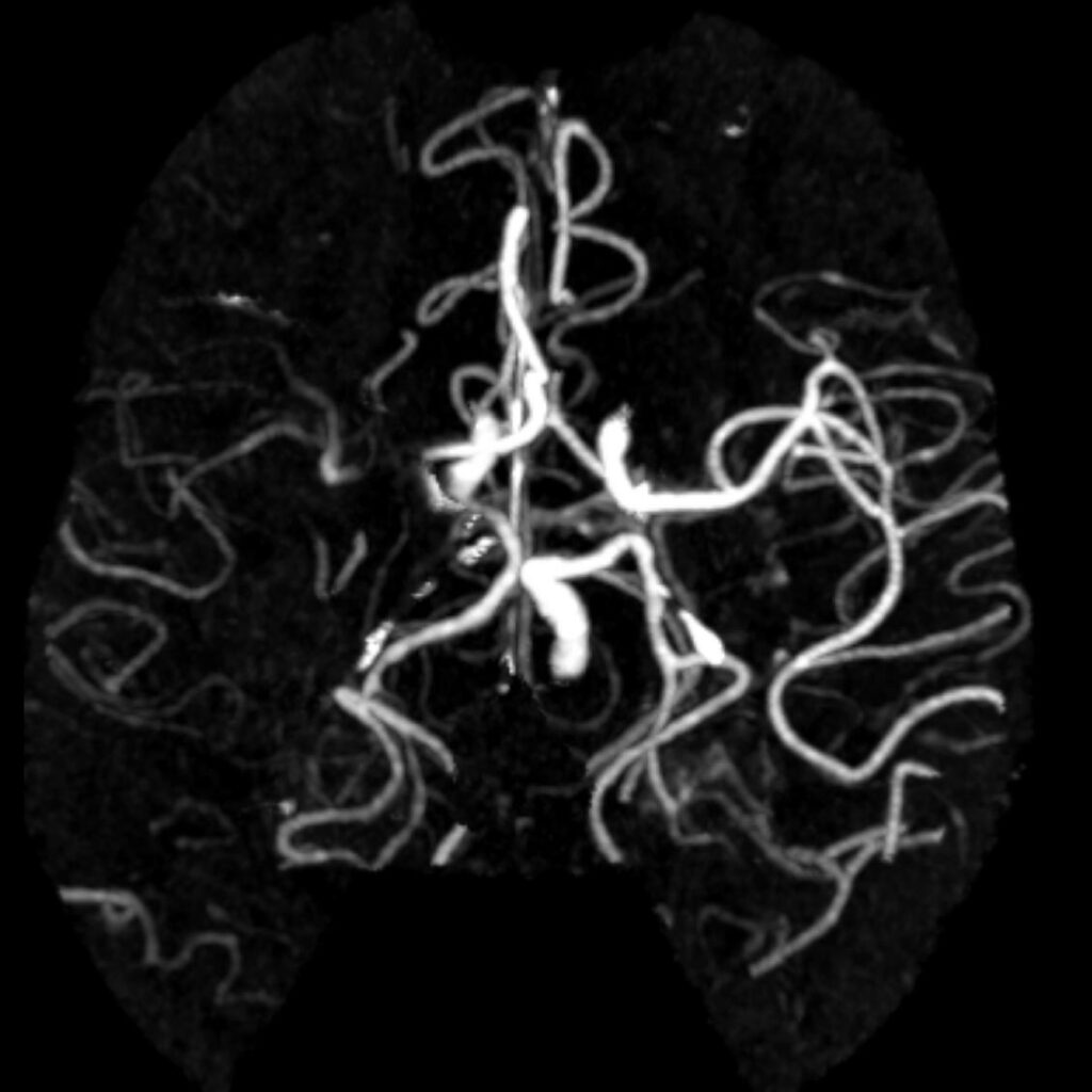 Case 02 CT Angiogram