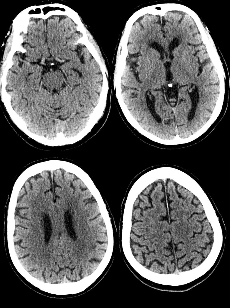 Case 03 CT