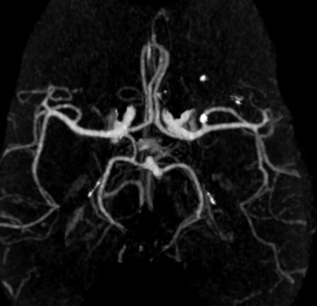 Case 03 CT Angiogram