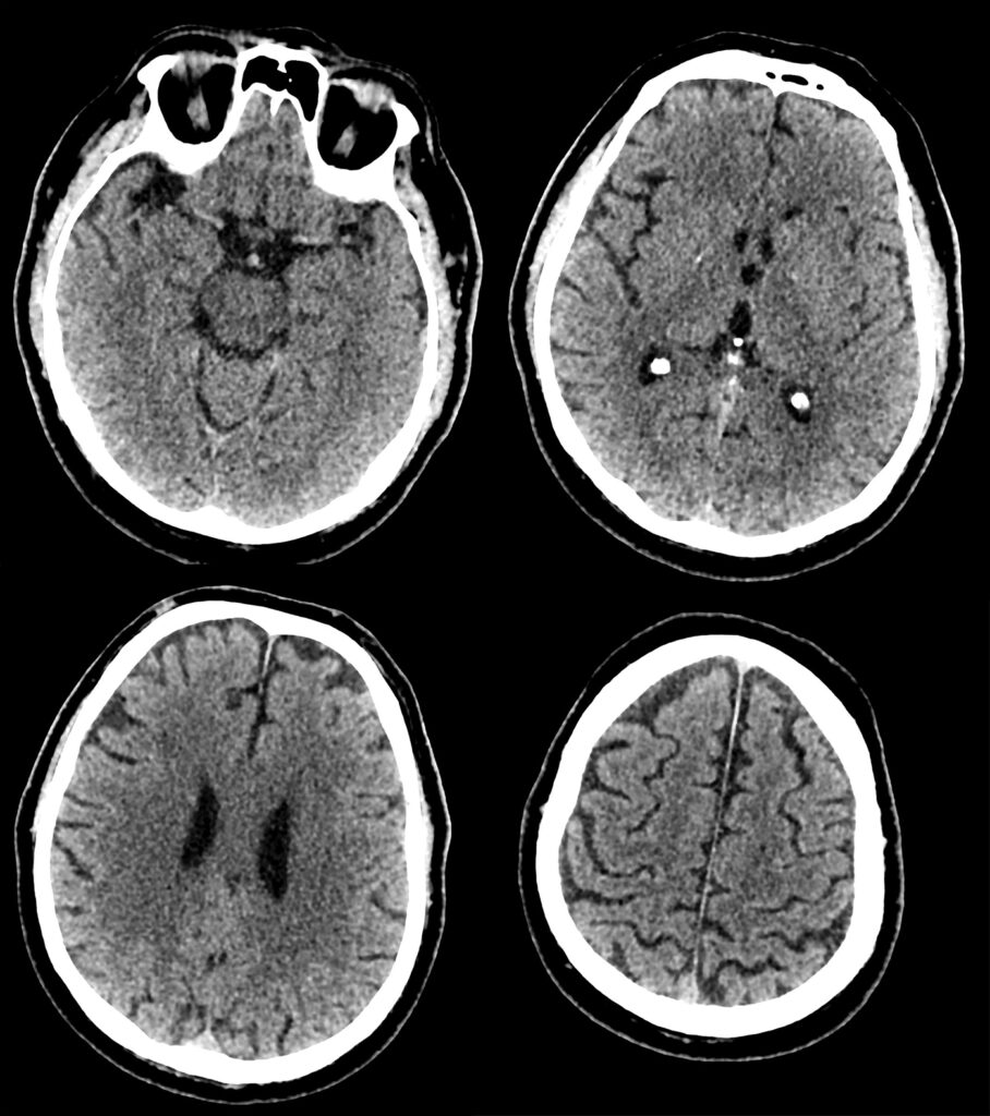 Case 04 CT