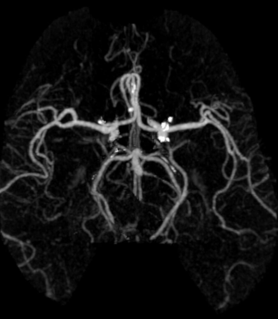 Case 04 CT Angiogram