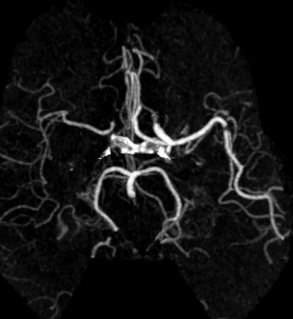 Case 05 CT Angiogram