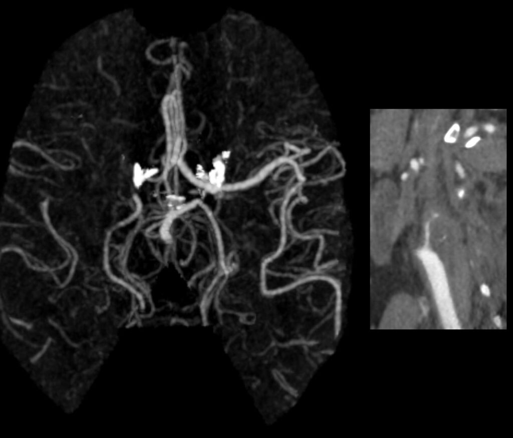 Case 06 CT Angiogram