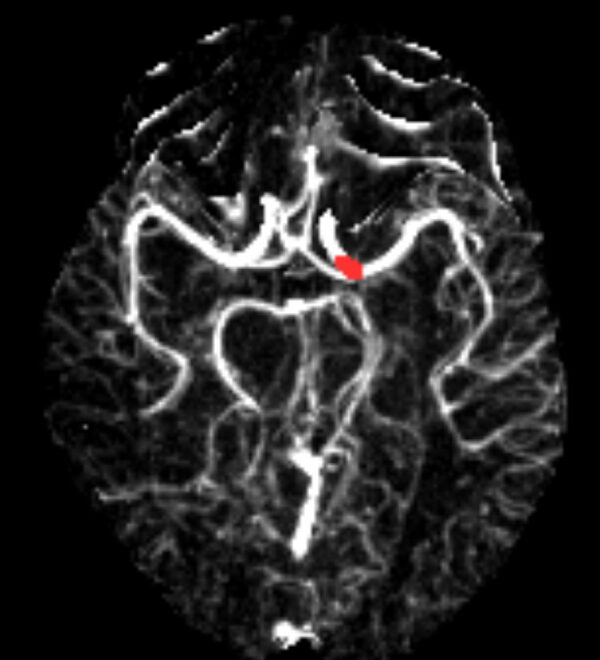 Case 07 CT Angiogram