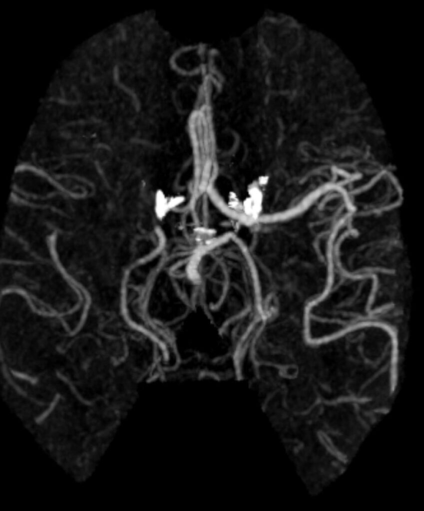 Case 08 CT Angiogram