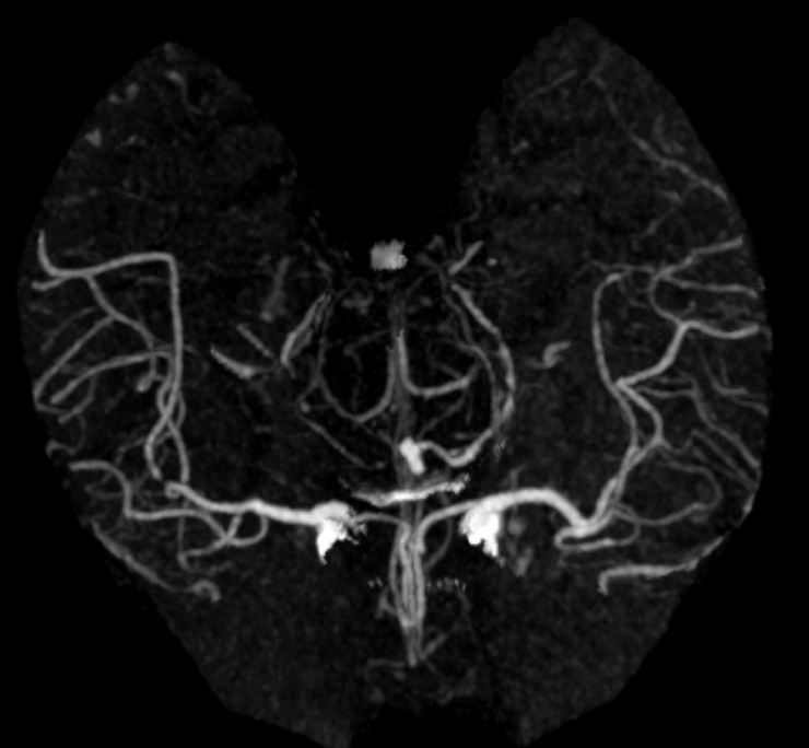Case 09 CT Angiogram