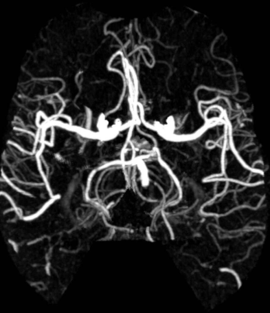 Case 10 CT Angiogram