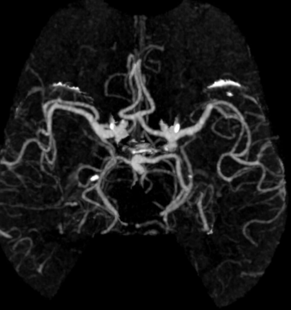 Case 11 CT Angiogram