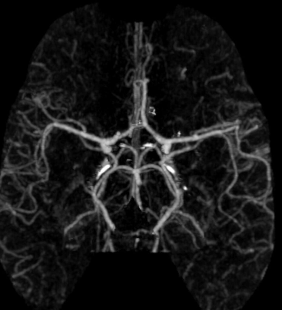Case 12 CT Angiogram