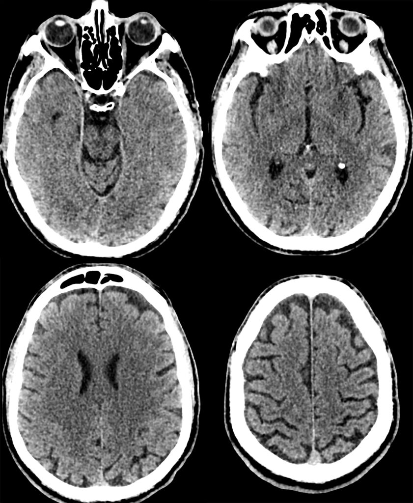 Case 13 CT