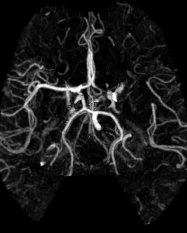 Case 13 CT Angiogram