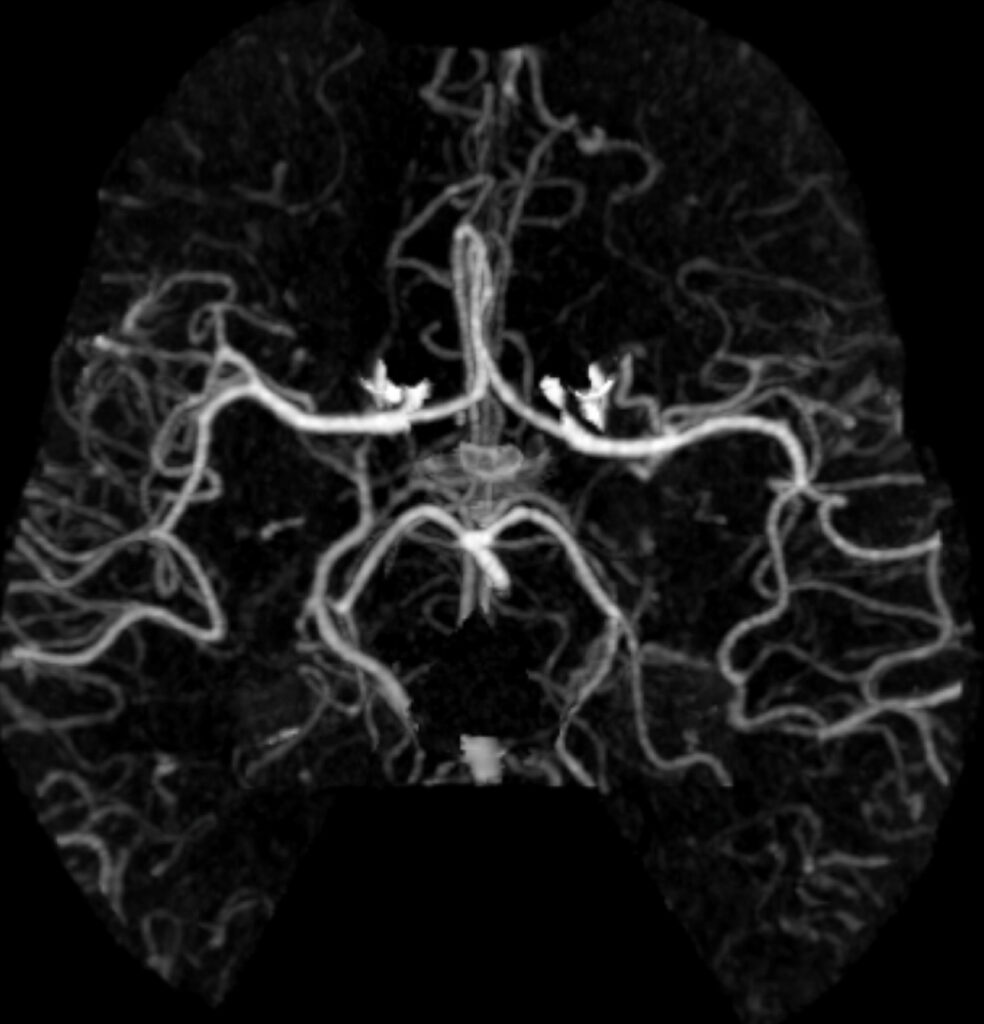 Case 15 CT Angiogram