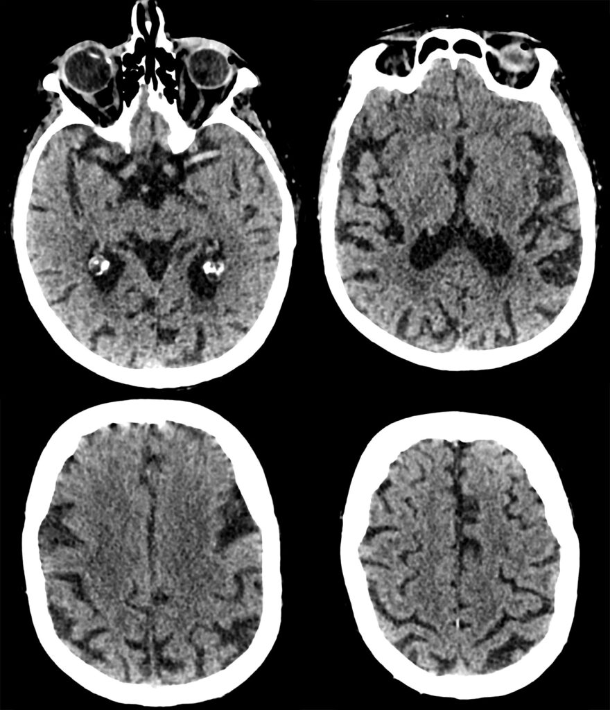 Case 16 CT