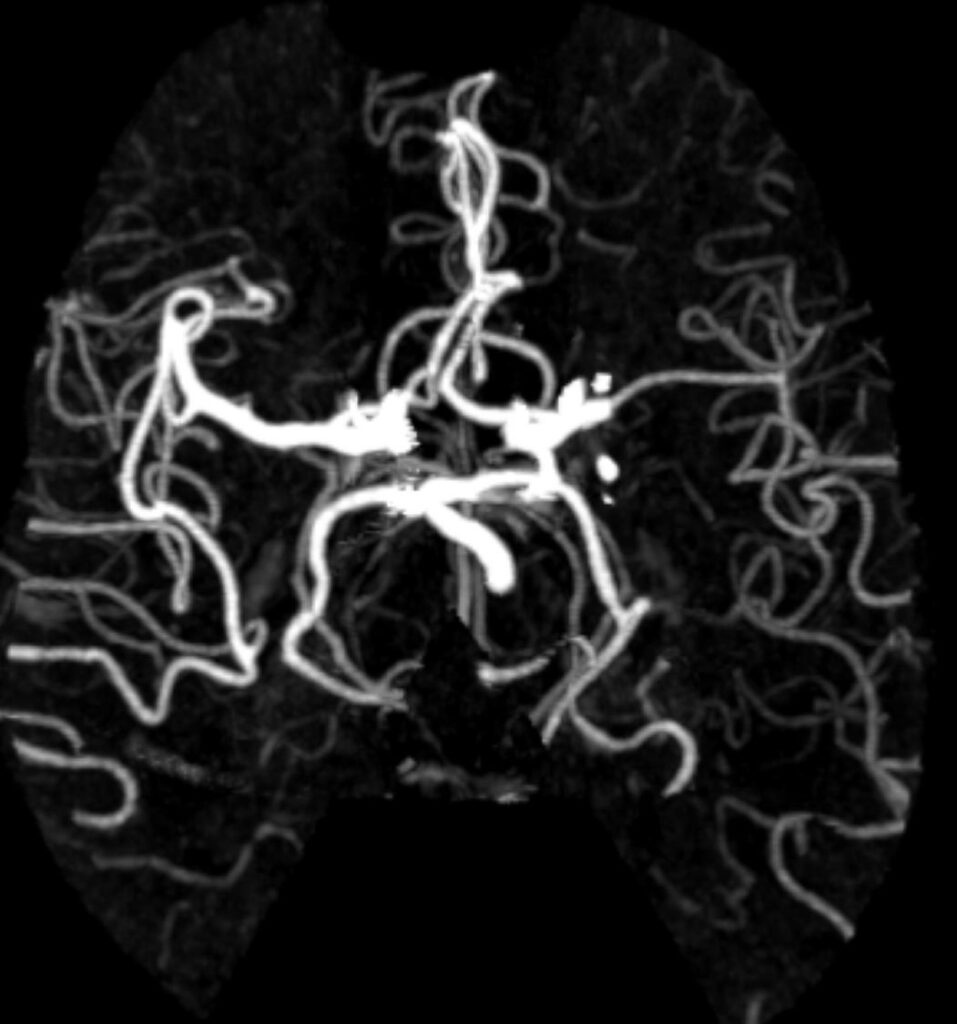 Case 16 CT Angiogram