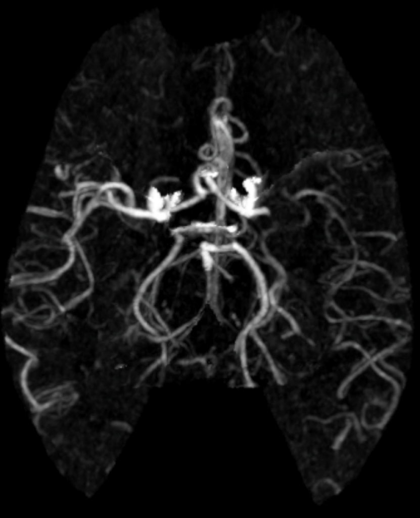 Case 17 CT Angiogram