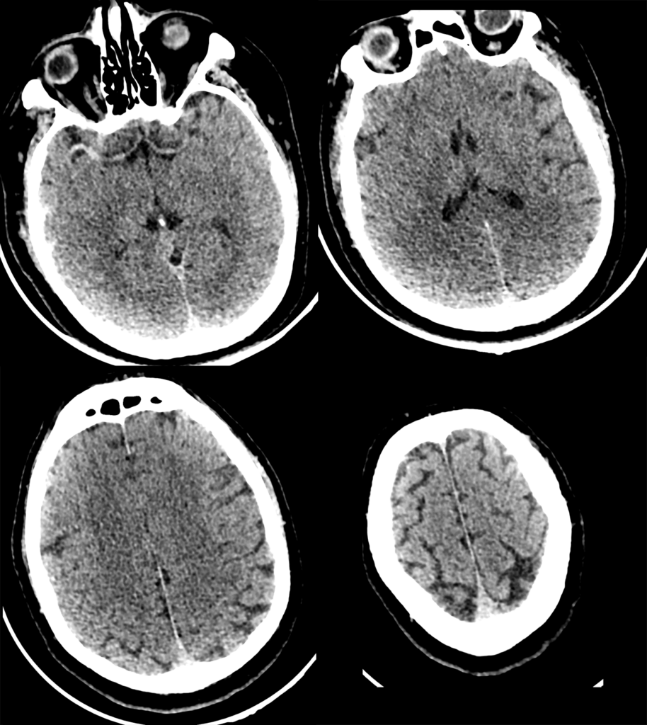 Case 18 CT