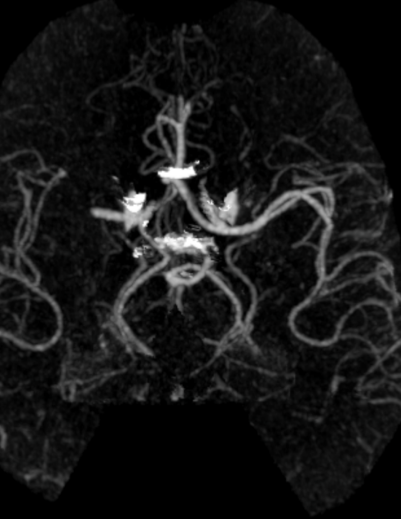 Case 18 CT Angiogram