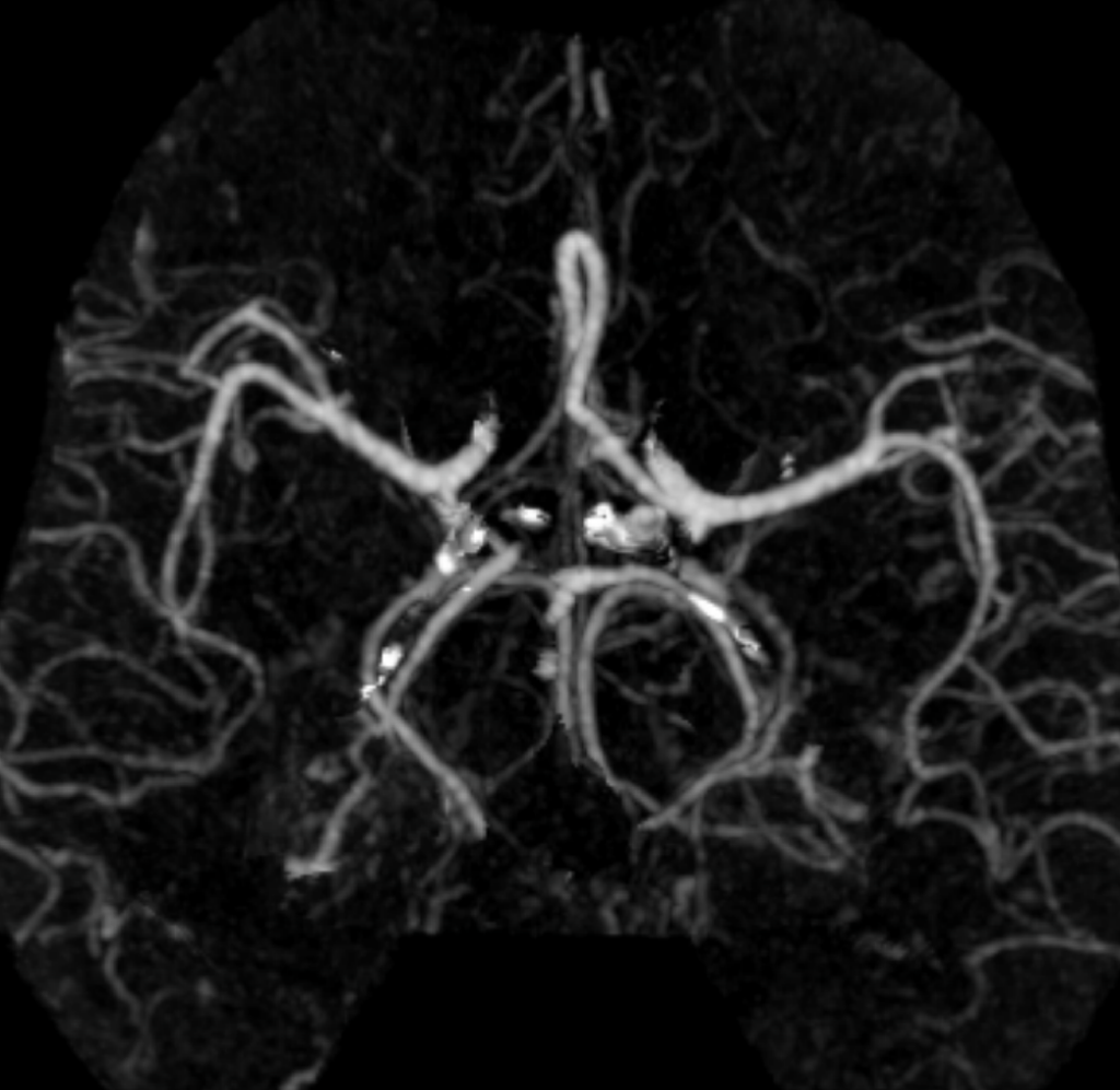 Case 19 CT Angiogram