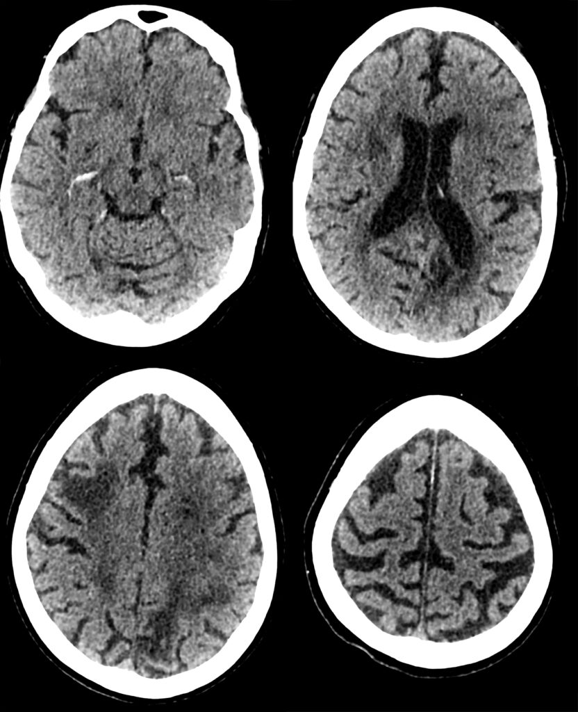 Case 20 CT