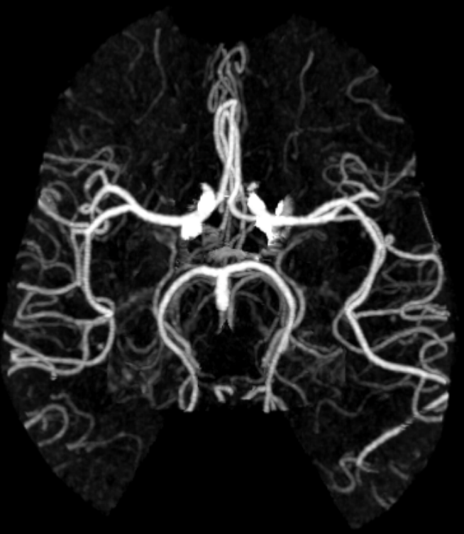 Case 20 CT Angiogram